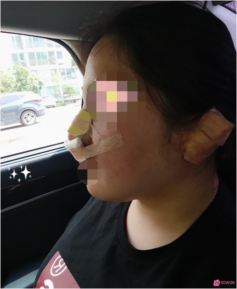 여자복코 코끝성형수술 얼굴 중심 자신감 되찾기 사진 7