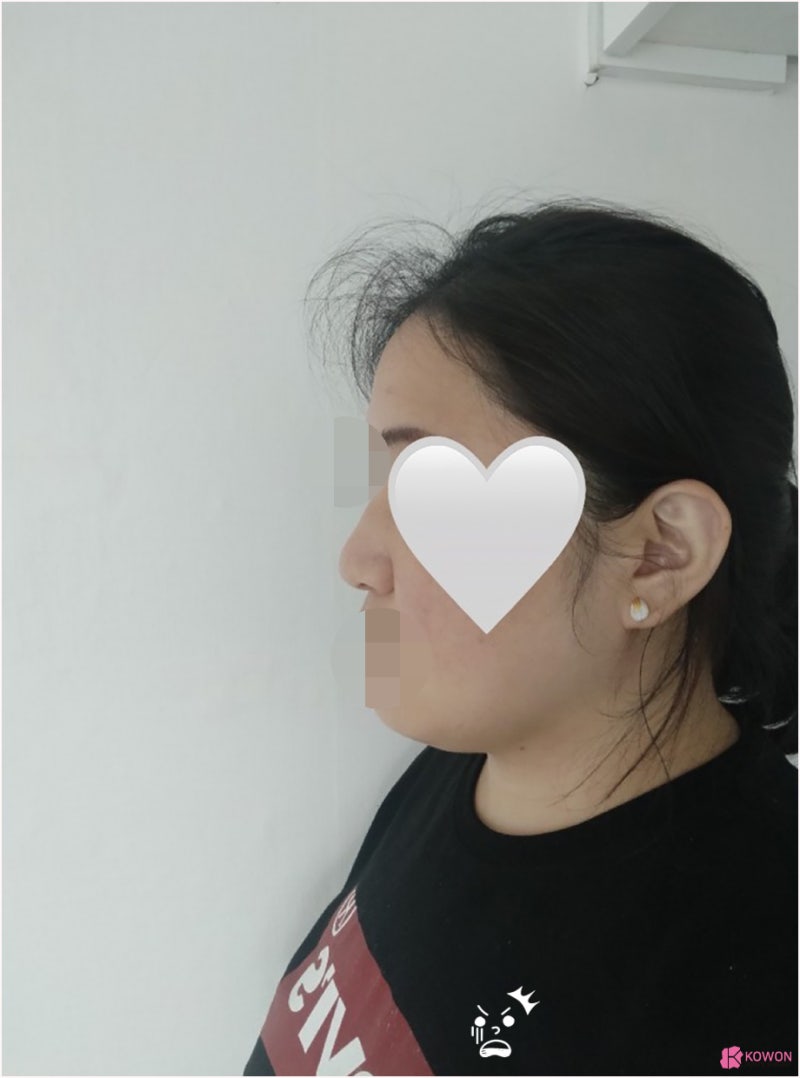 여자복코 코끝성형수술 얼굴 중심 자신감 되찾기 사진 3