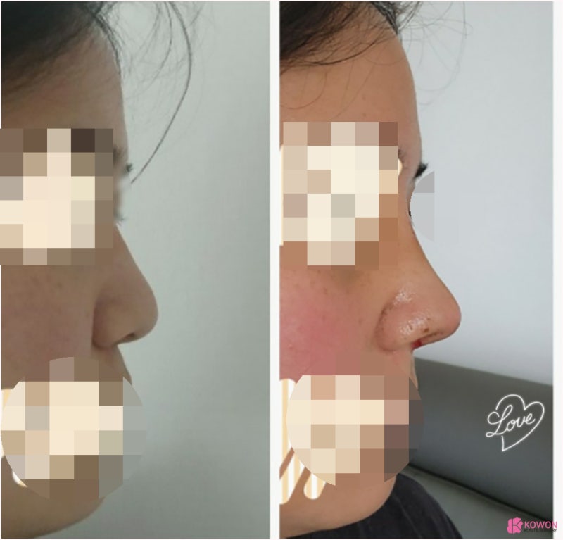 여자복코 코끝성형수술 얼굴 중심 자신감 되찾기 사진 10