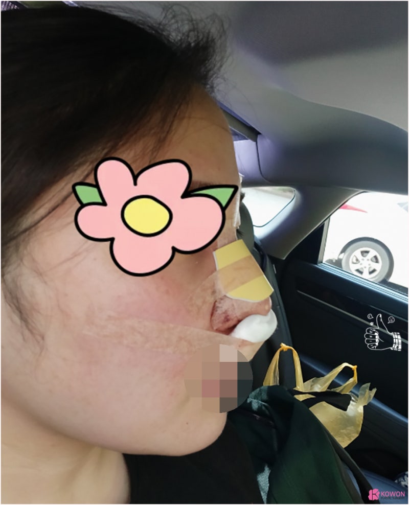 여자복코 코끝성형수술 얼굴 중심 자신감 되찾기 사진 5