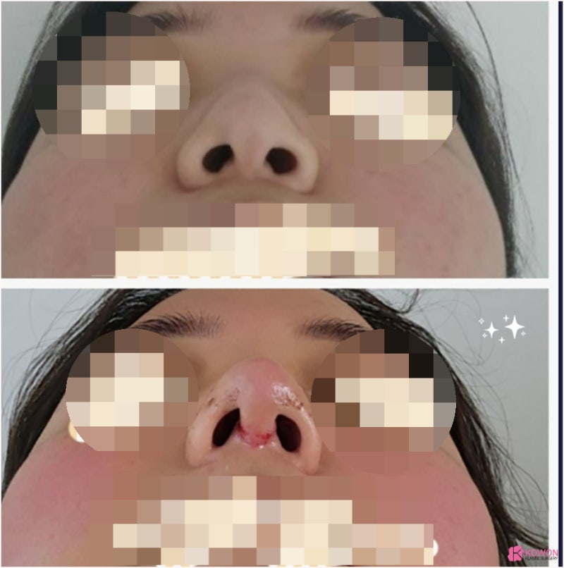 여자복코 코끝성형수술 얼굴 중심 자신감 되찾기 사진 12