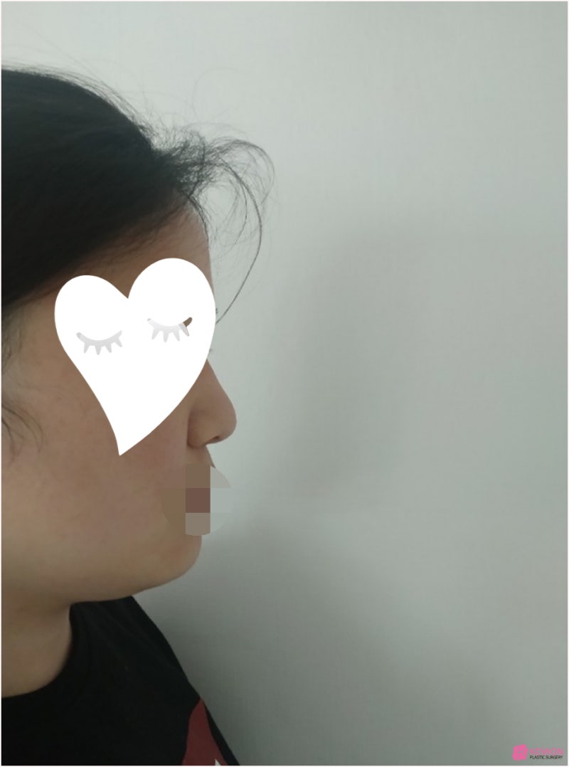 여자복코 코끝성형수술 얼굴 중심 자신감 되찾기 사진 2