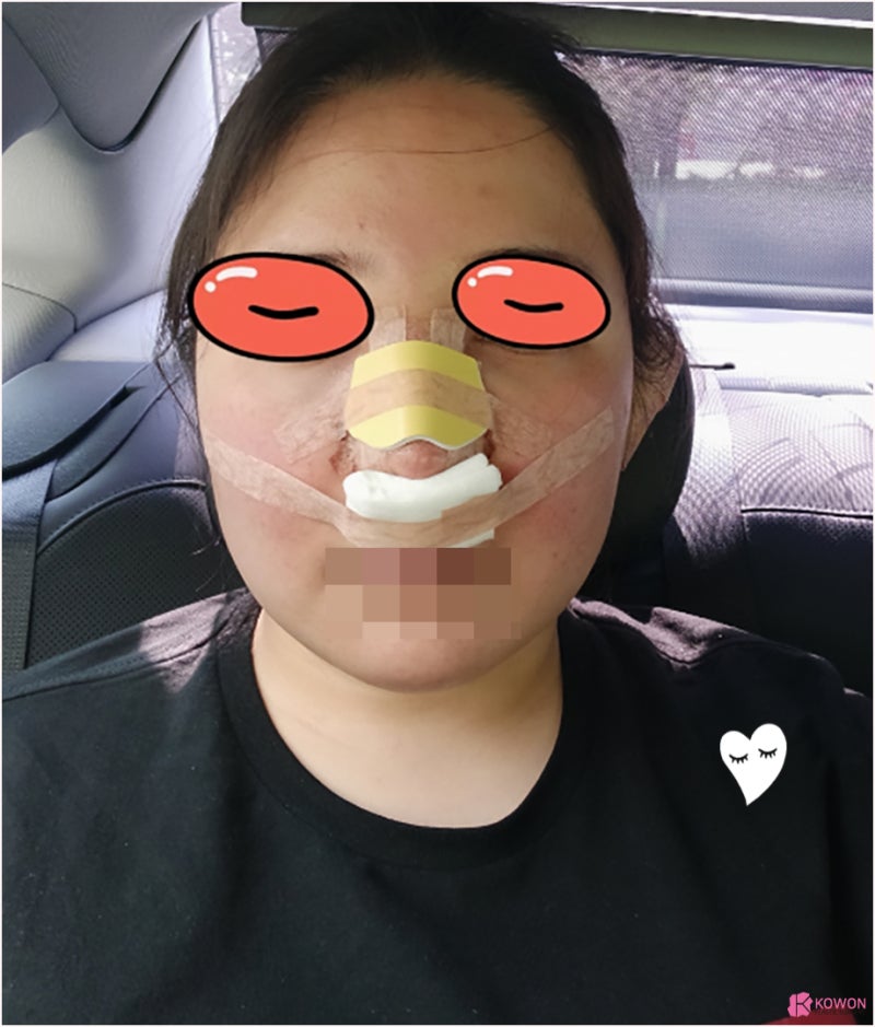 여자복코 코끝성형수술 얼굴 중심 자신감 되찾기 사진 6