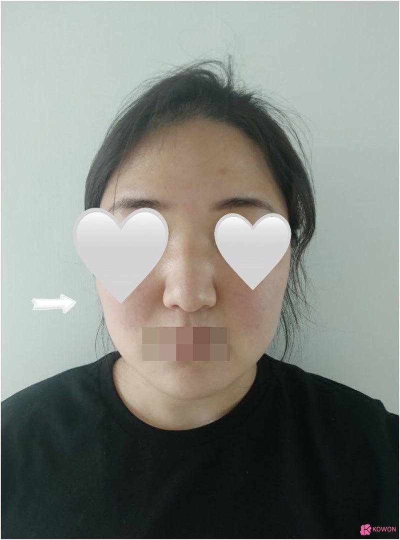 여자복코 코끝성형수술 얼굴 중심 자신감 되찾기 사진 4