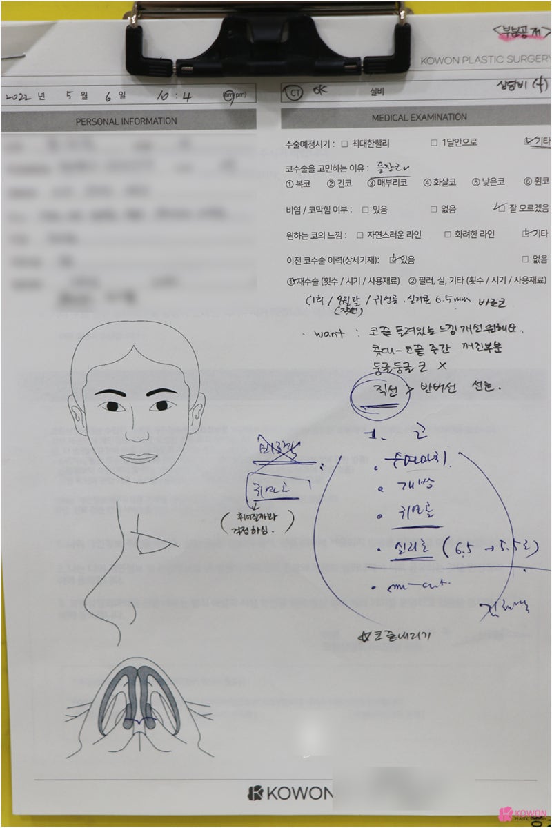 남자코재수술 들린코 짝짝이 콧구멍 노출 교정