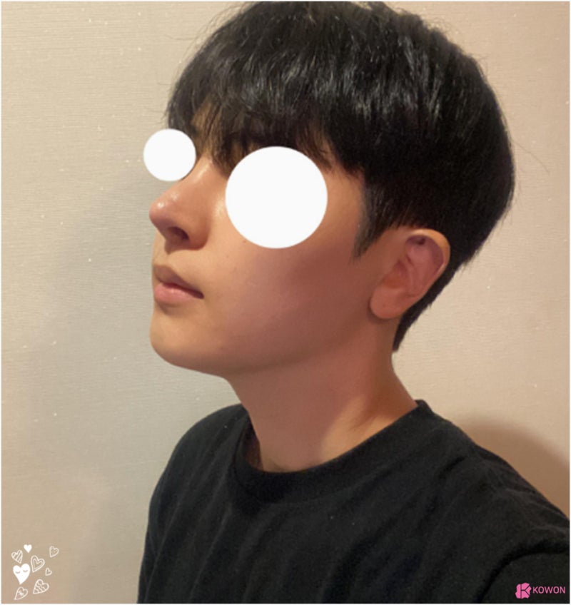 남자코재수술 들린코 짝짝이 콧구멍 노출 교정 사진 11