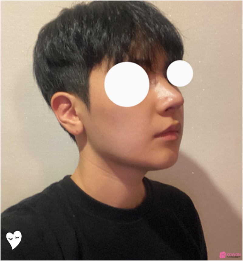 남자코재수술 들린코 짝짝이 콧구멍 노출 교정 사진 10