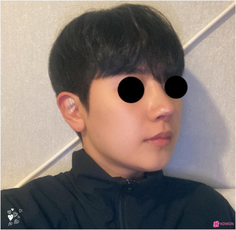 남자코재수술 들린코 짝짝이 콧구멍 노출 교정 사진 7