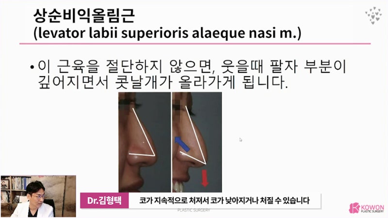 긴코성형전후 웃을때화살코 원인 근육 절단 모양 상담 사진 6