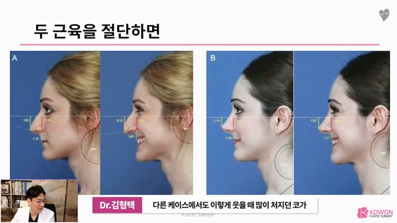 긴코성형전후 웃을때화살코 원인 근육 절단 모양 상담 사진 7