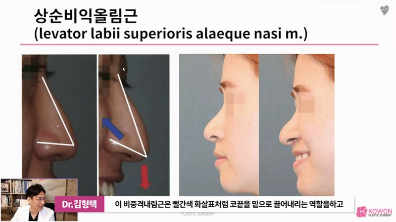 긴코성형전후 웃을때화살코 원인 근육 절단 모양 상담 사진 4