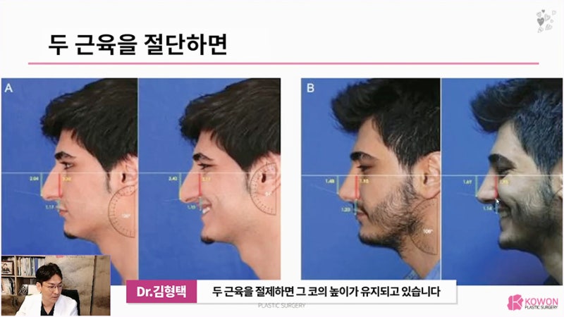 긴코성형전후 웃을때화살코 원인 근육 절단 모양 상담 사진 8