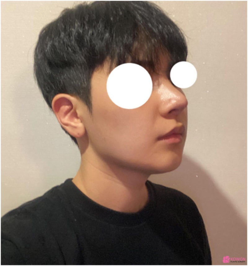 논현역성형외과 남자 서울코재수술 사례 사진 10