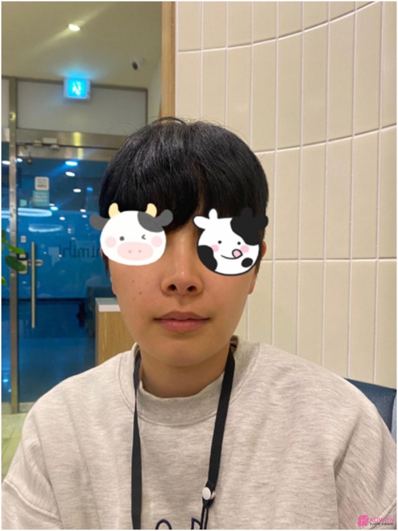 논현역성형외과 남자 서울코재수술 사례 사진 3