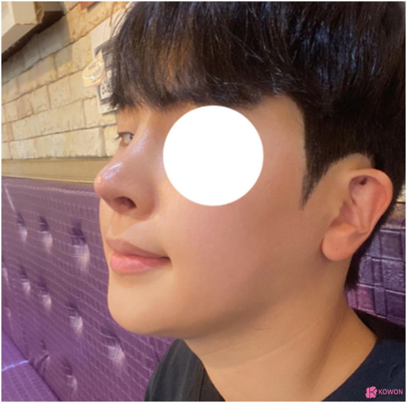 논현역성형외과 남자 서울코재수술 사례 사진 13