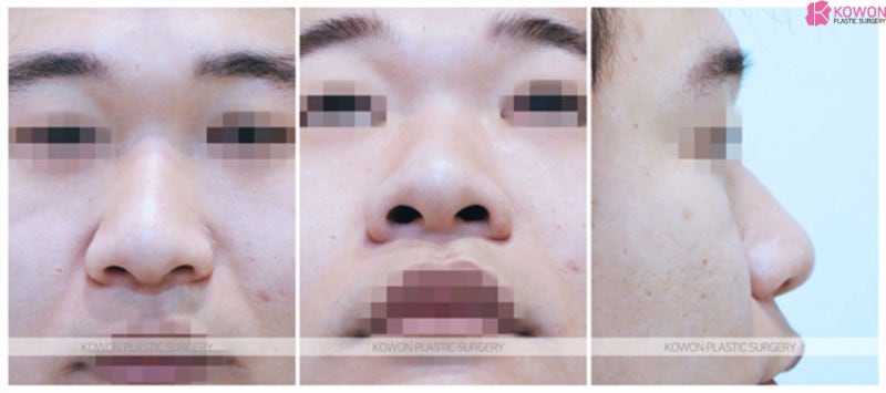 복코성형외과 낮은복코 둔해 보이는 인상 개선 사진 2