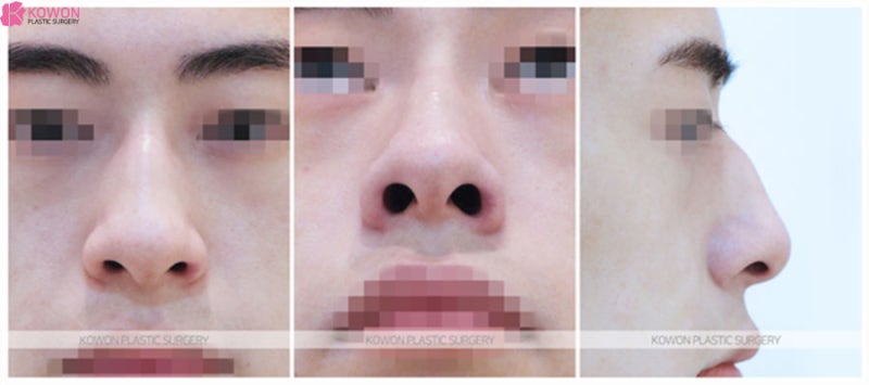 코성형외과유명한곳 남자무보형물 수술 사례 사진 2