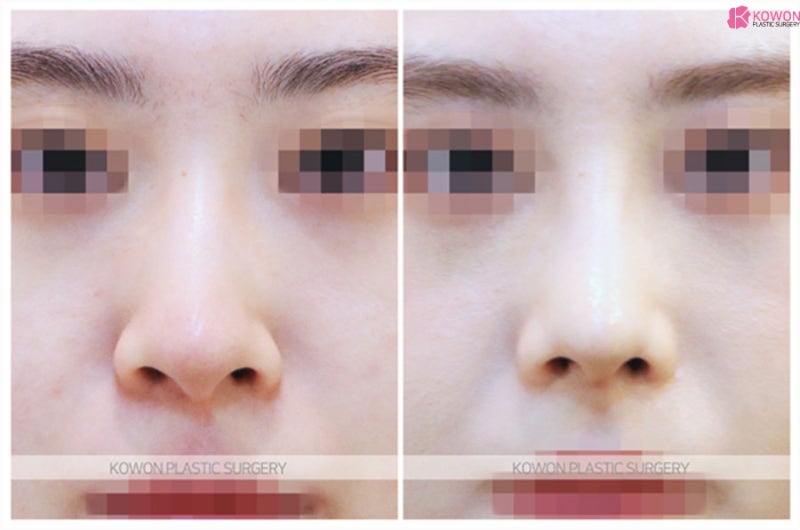 코휘어짐수술 코끝연골묶기후기 콤플렉스 해결 사진 6