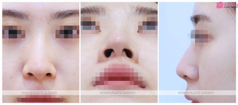 코휘어짐수술 코끝연골묶기후기 콤플렉스 해결 사진 2