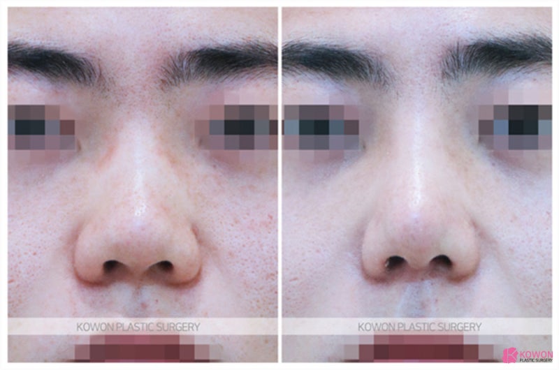 비중격성형 비염코성형수술 기능 문제 개선 사진 6