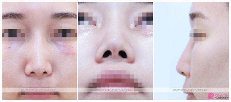 코잘하는성형외과 코실리프팅제거 비중격 수술 사진 2