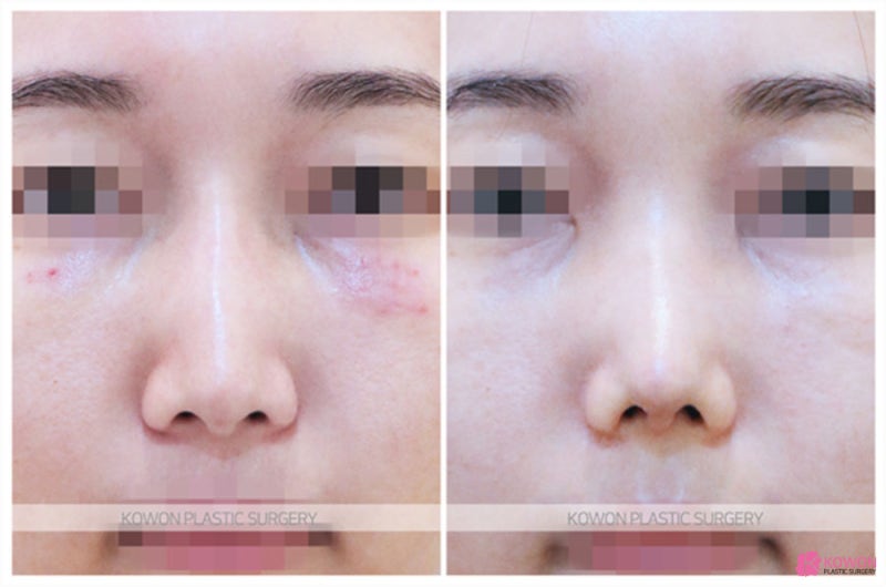 코잘하는성형외과 코실리프팅제거 비중격 수술 사진 8