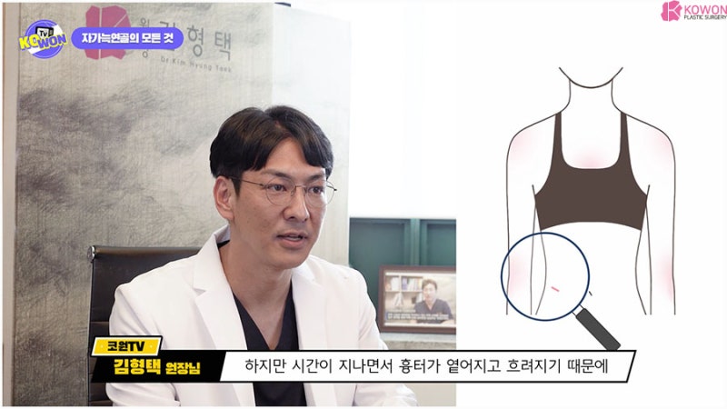 자가조직코성형 장단점 늑연골흉터 유지력 사진 9