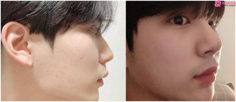 서초동성형외과 화려한 모양 남성코성형 잘하는 곳