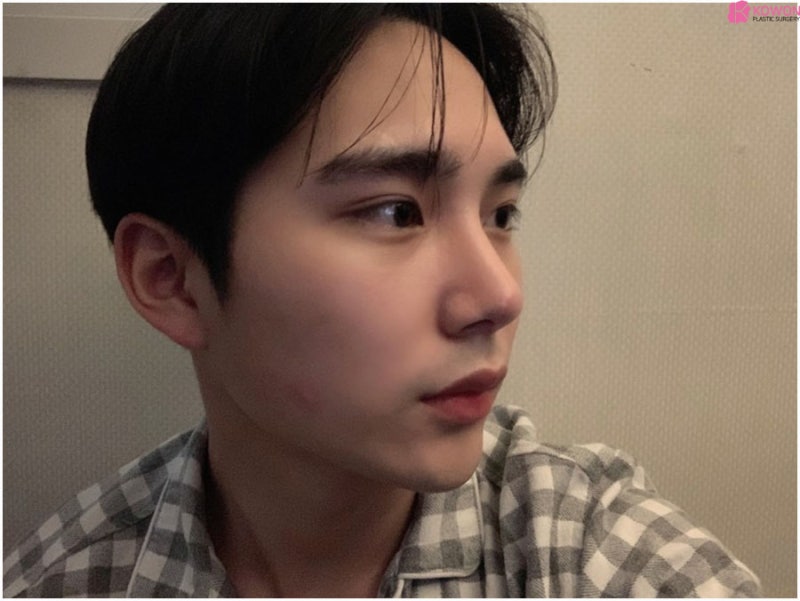 서초동성형외과 화려한 모양 남성코성형 잘하는 곳 사진 5