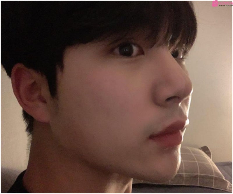 서초동성형외과 화려한 모양 남성코성형 잘하는 곳 사진 11