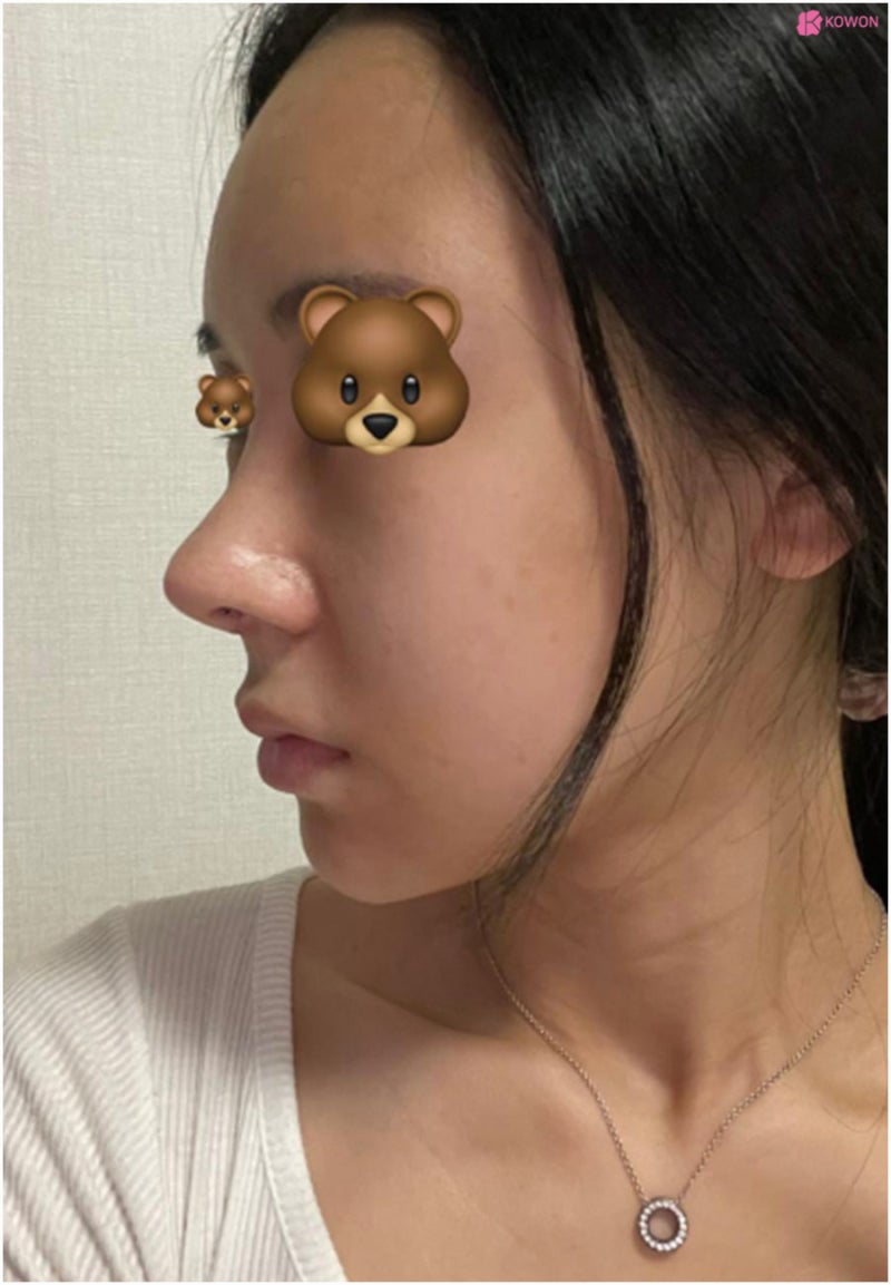 서울코성형잘하는곳 비순각 여자코수술후기 사진 6