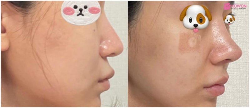 서울코성형잘하는곳 비순각 여자코수술후기 사진 10
