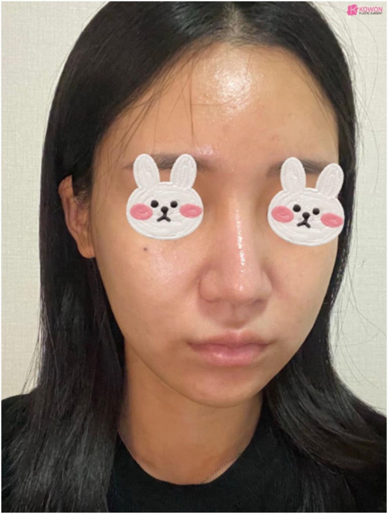 서울코성형잘하는곳 비순각 여자코수술후기 사진 3