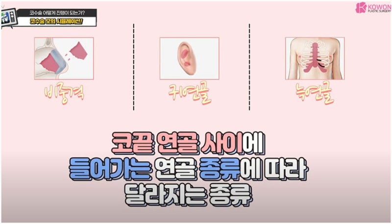 매부리코성형 방법 과정 특징 코성형전문의 사진 6