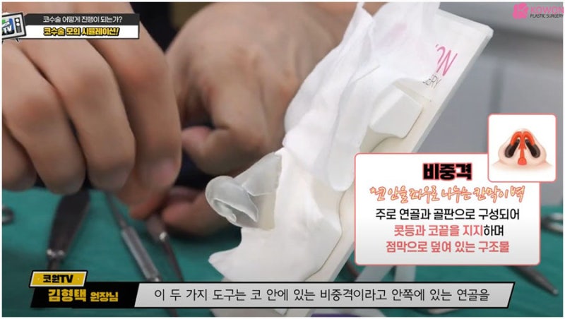 매부리코성형 방법 과정 특징 코성형전문의 사진 4