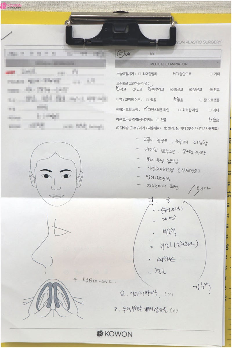 강남코성형유명한곳 울퉁불퉁 여자매부리코교정 사진 2