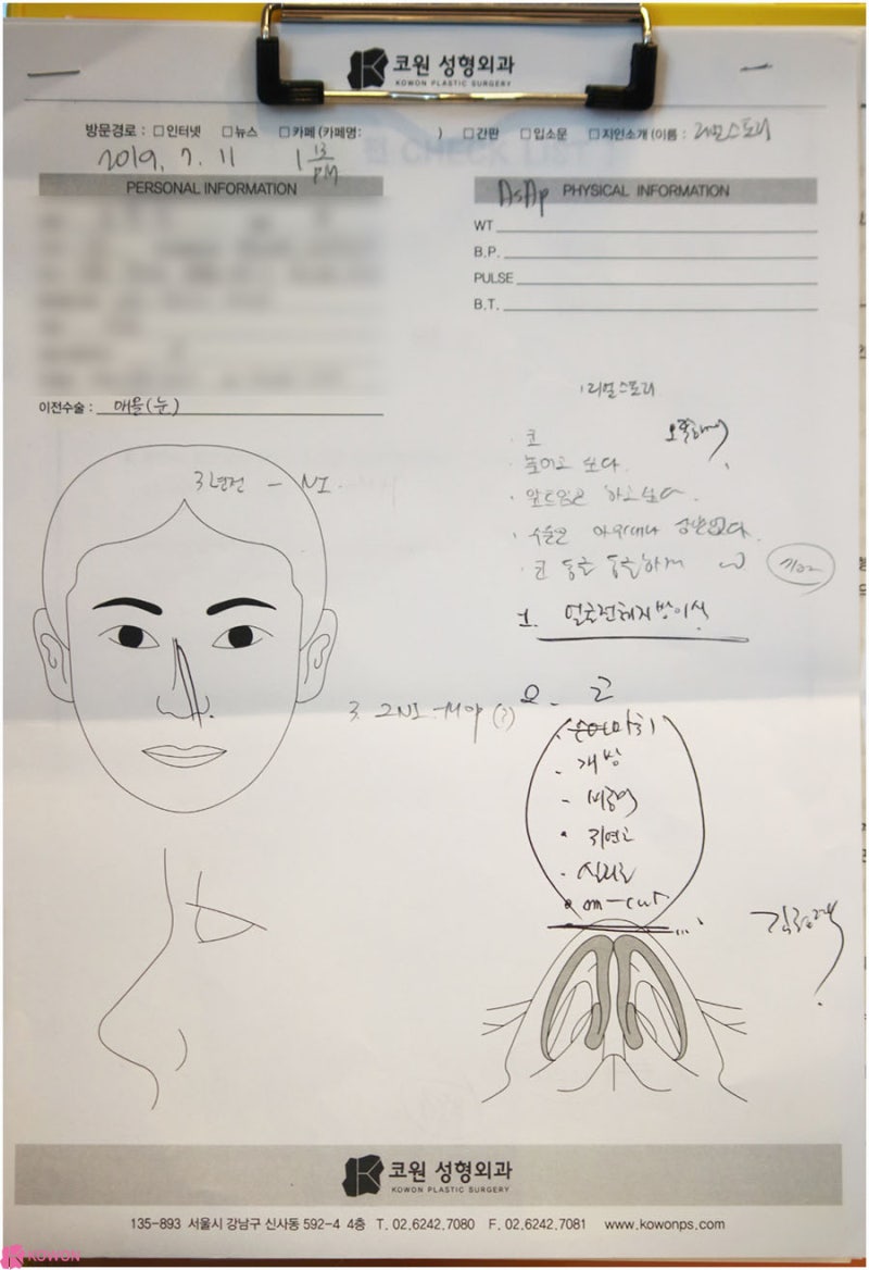 서울코성형 귀연골코수술 전후 비교 이미지 차이 사진 2
