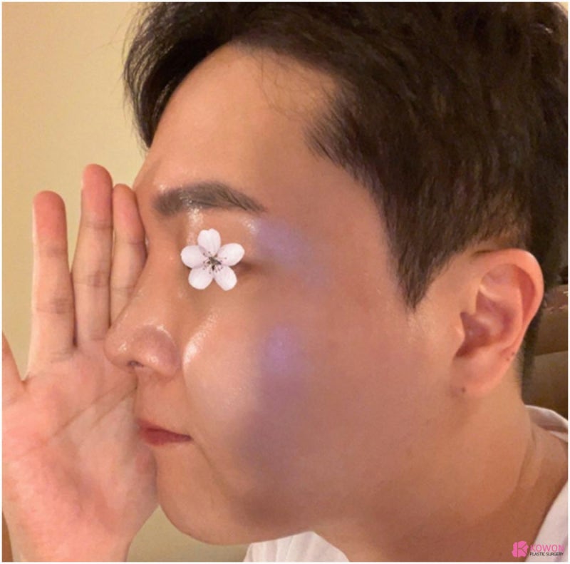 코재성형 들창코 콧구멍 노출 개선 강남구성형외과 사진 8