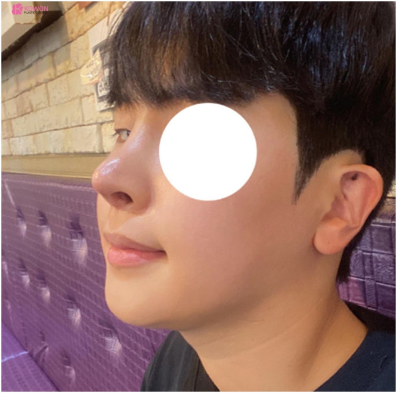 코실리콘부작용 비주 튀어나옴 해결 강남구청성형외과 사진 12