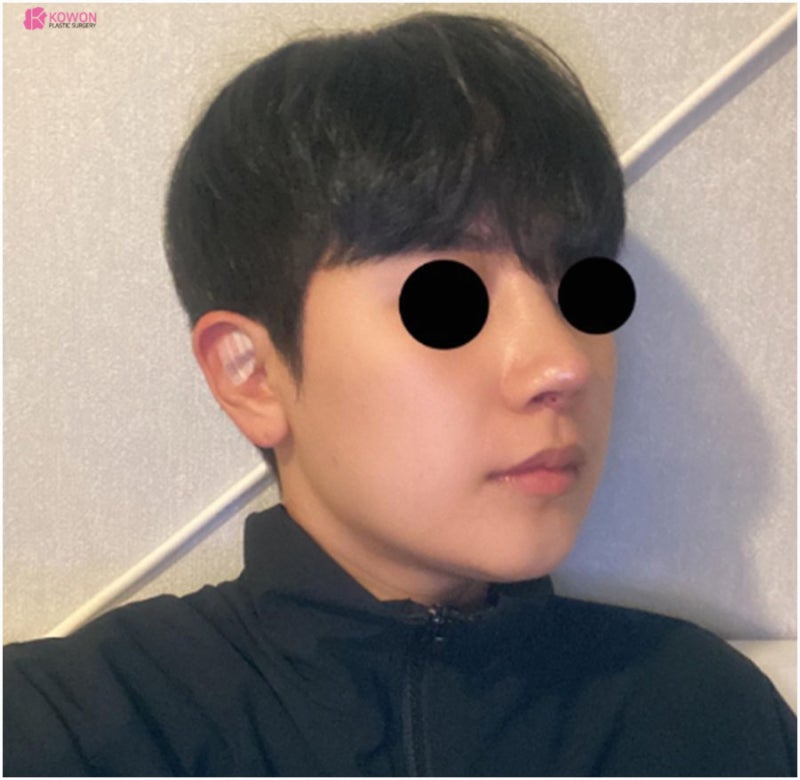 코실리콘부작용 비주 튀어나옴 해결 강남구청성형외과 사진 6