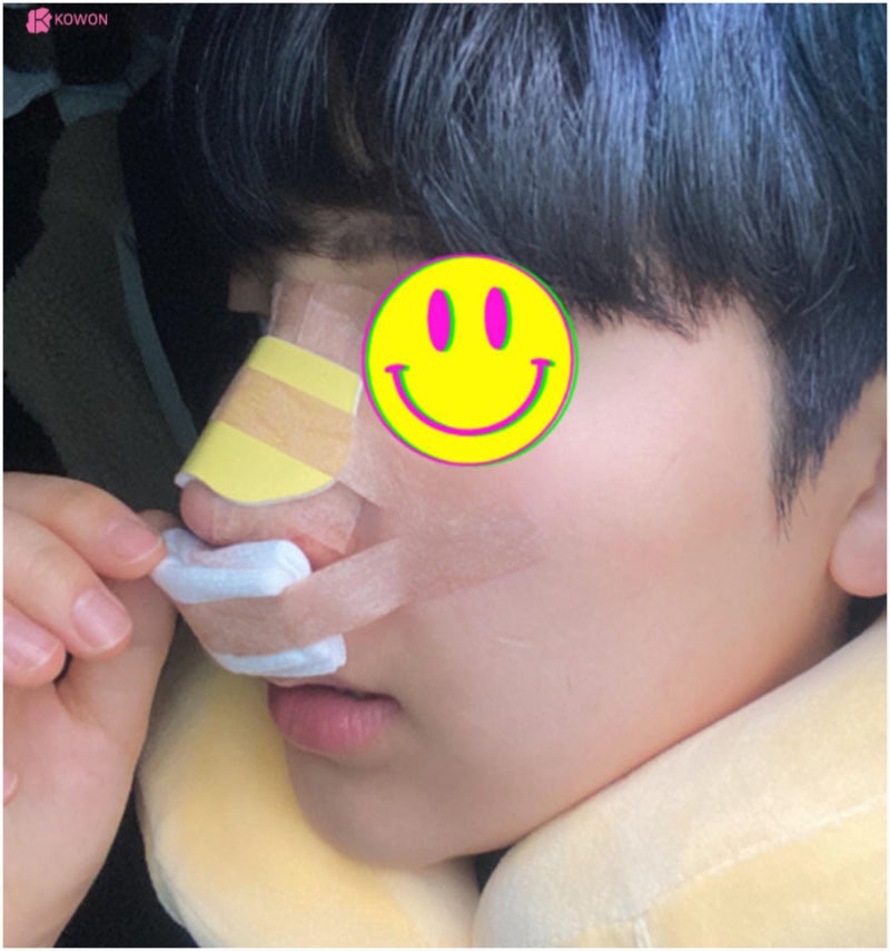 코실리콘부작용 비주 튀어나옴 해결 강남구청성형외과 사진 5