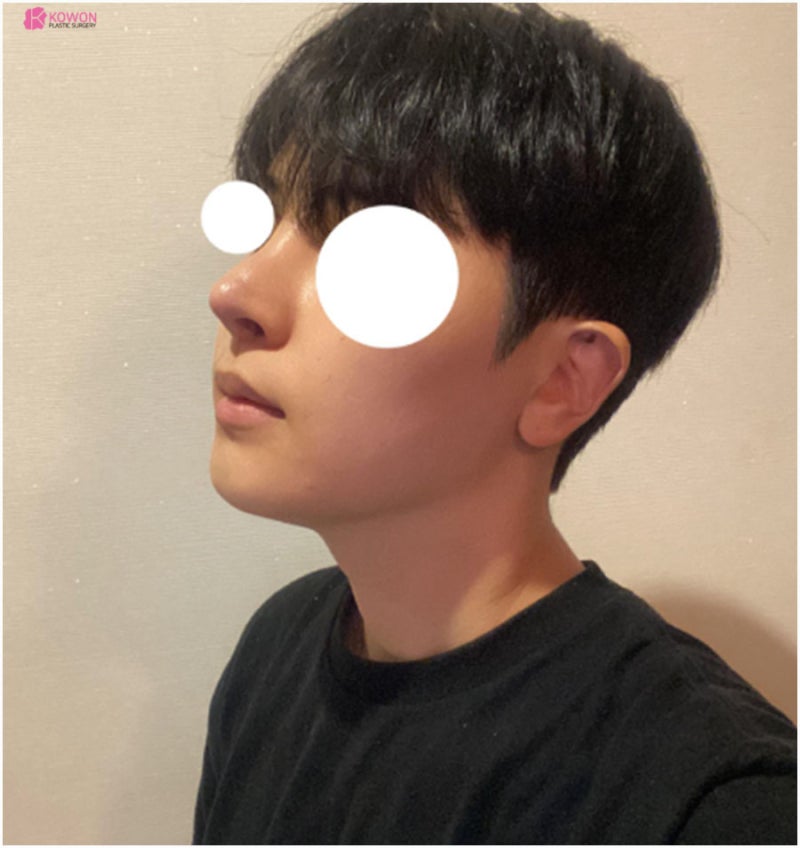 코실리콘부작용 비주 튀어나옴 해결 강남구청성형외과 사진 10