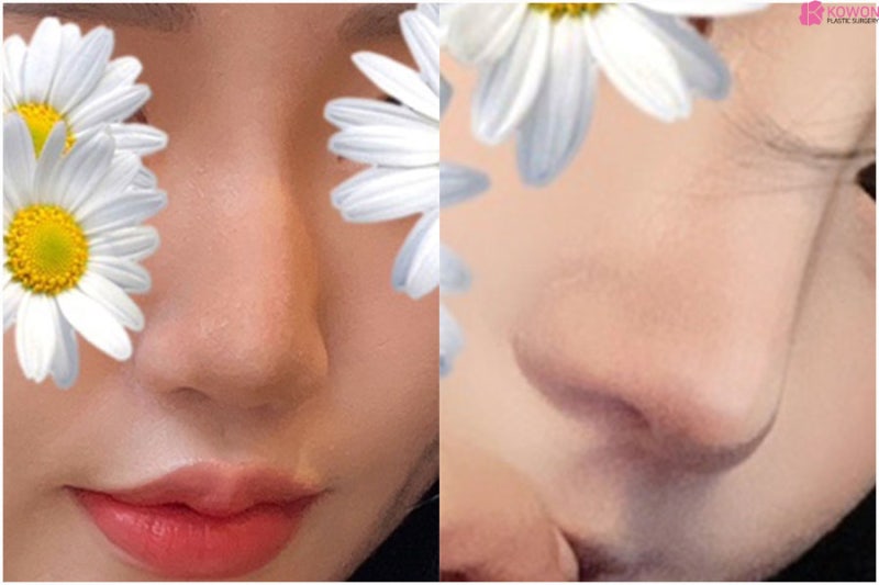 신사역성형외과추천 코자가늑수술 사례 전후 비교