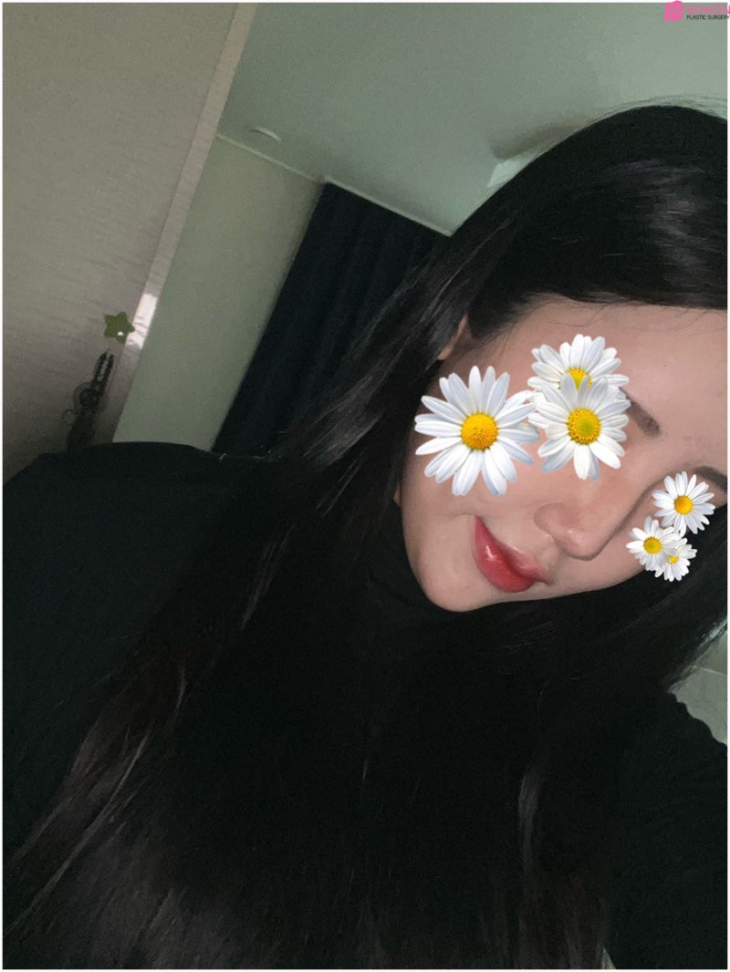 신사역성형외과추천 코자가늑수술 사례 전후 비교 사진 2