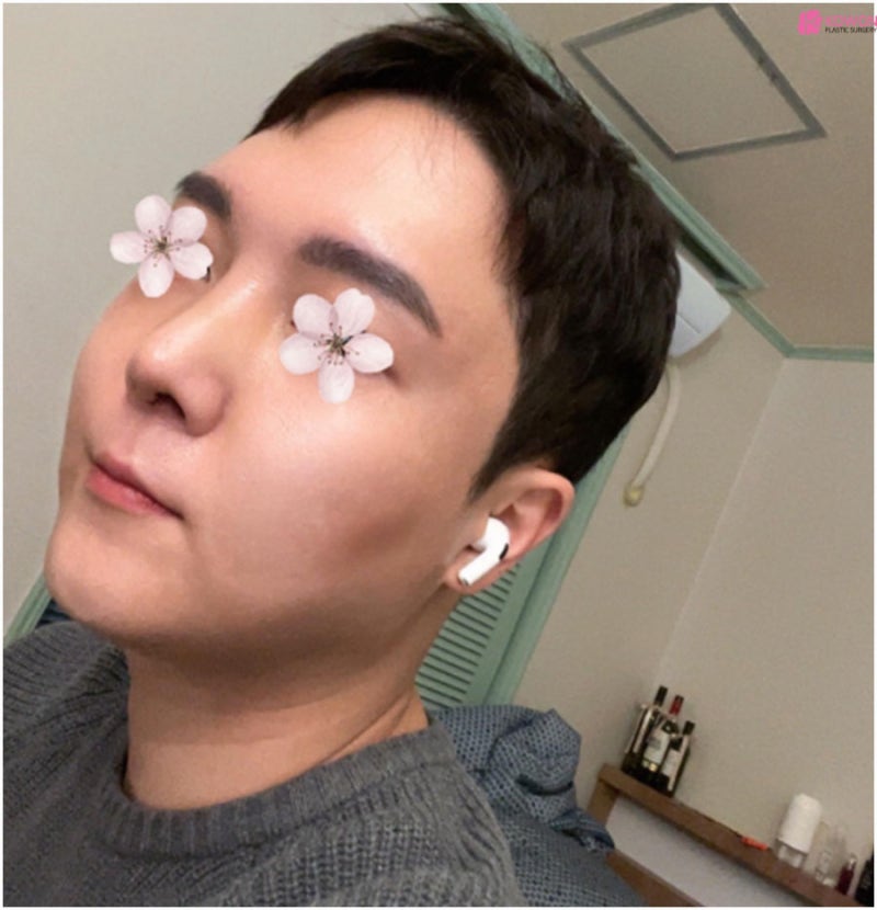 강남유명한성형외과 남자 비중격코재수술 사진 6