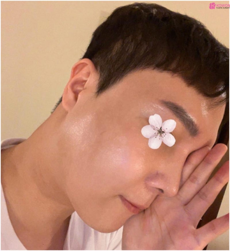 강남유명한성형외과 남자 비중격코재수술 사진 7