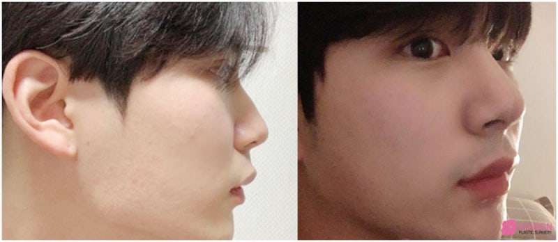 강남코성형외과추천 비염수술후재발 교정 수술