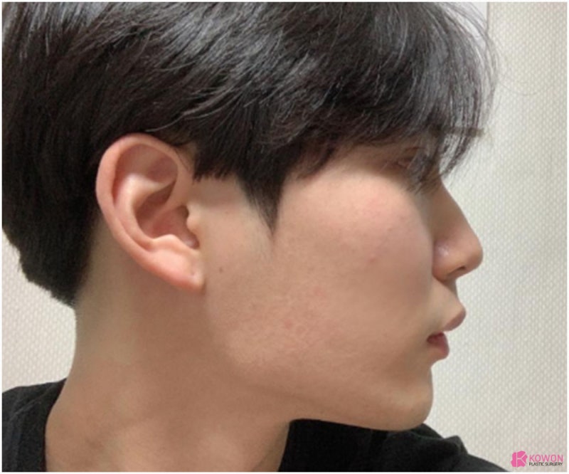 강남코성형외과추천 비염수술후재발 교정 수술 사진 4
