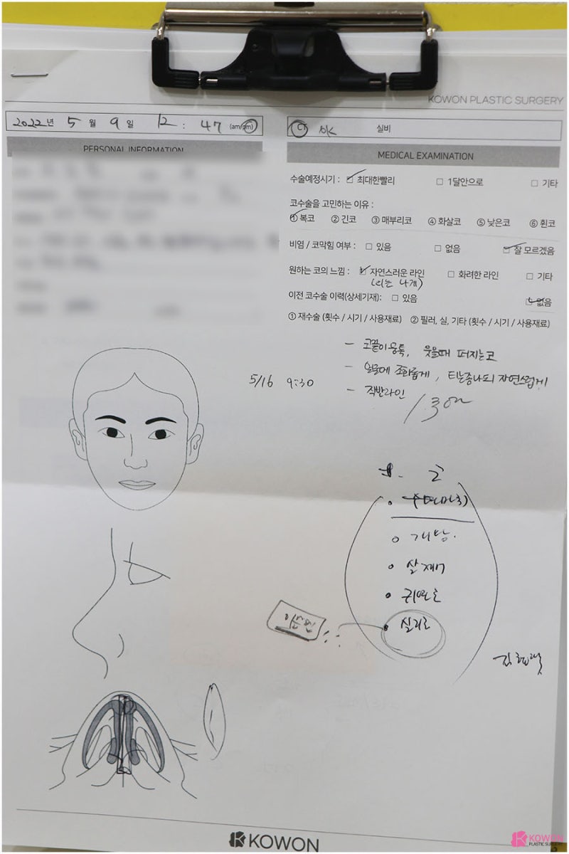 퍼진코 둥글고 납작한 모양 코끝올리기 사례