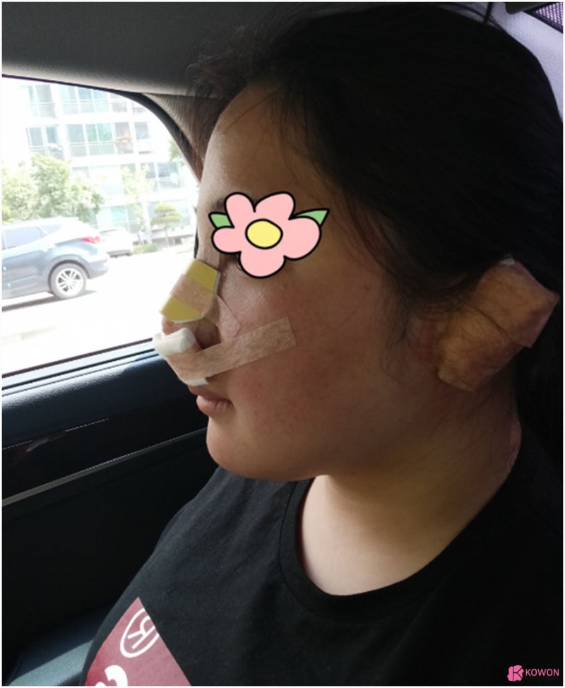 퍼진코 둥글고 납작한 모양 코끝올리기 사례 사진 7
